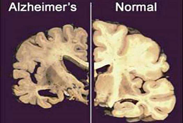 Τι είναι η νόσος Alzheimer, τα στάδιά της και η θεραπεία