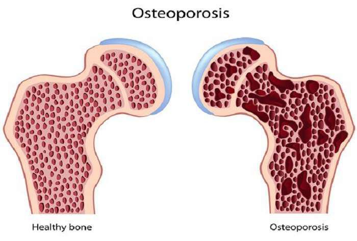 antimetopiste-tin-osteoporosi-me-fisika-mesa-2