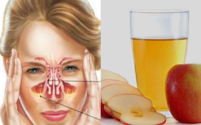 6 τρόποι να αντιμετωπίσετε την ιγμορίτιδα με μηλόξυδο