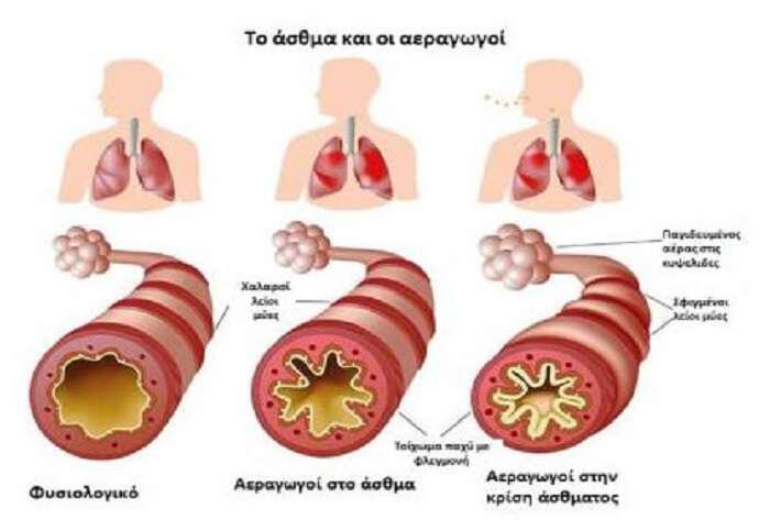 Καταπληκτική φυσική αντιμετώπιση και θεραπεία για το άσθμα