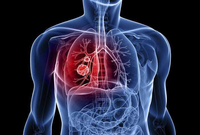 Καρκίνος του πνεύμονα: Αιτίες και συμπτώματα