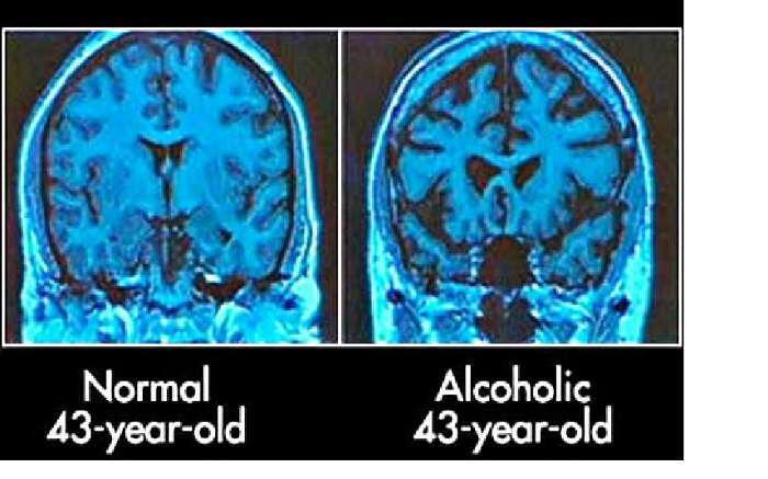 Το αλκοόλ προκαλεί βλάβες που παραμένουν ΜΌΝΙΜΑ στον εγκέφαλο
