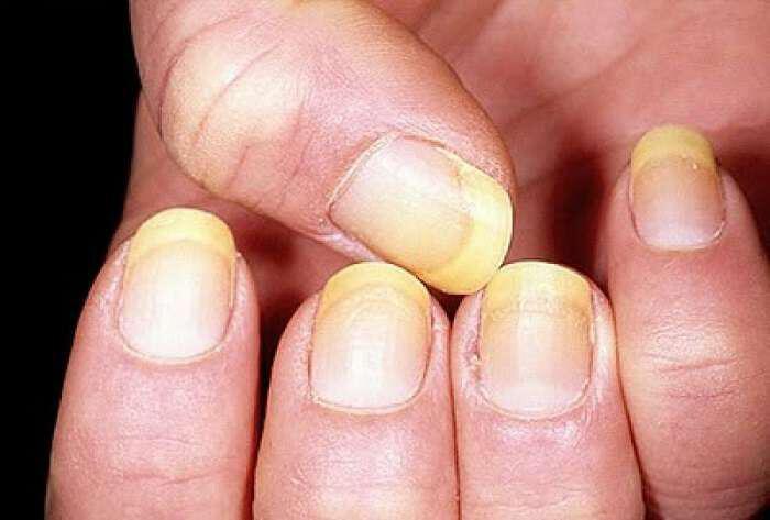Τι «λένε» τα νύχια για την υγεία σας κίτρινα