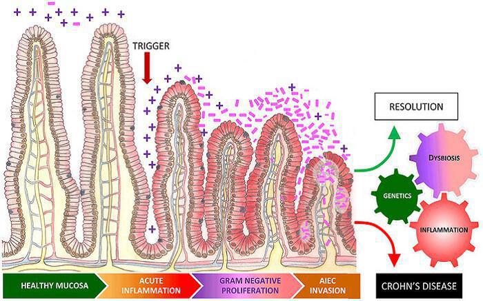Μικροβίωμα, Νόσος του Crohn, σύνδεση με E.coli και προβιοτικά
