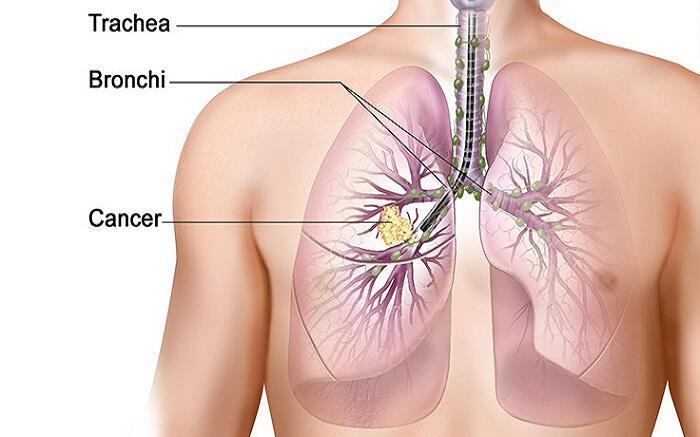 Βότανο σώζει ακόμη και καπνιστές από καρκίνο του πνεύμονα