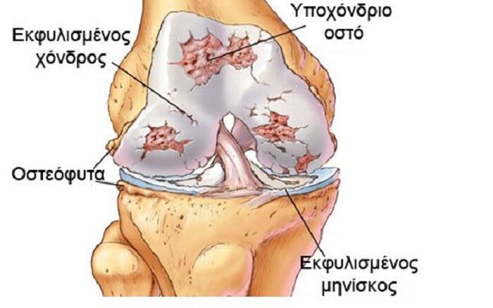Πως μπορεί να αναγεννηθεί ο χόνδρος στο γόνατο