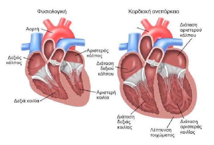Καρδιακή ανεπάρκεια: Το 50% καταλήγει εντός πενταετίας, από την διάγνωση
