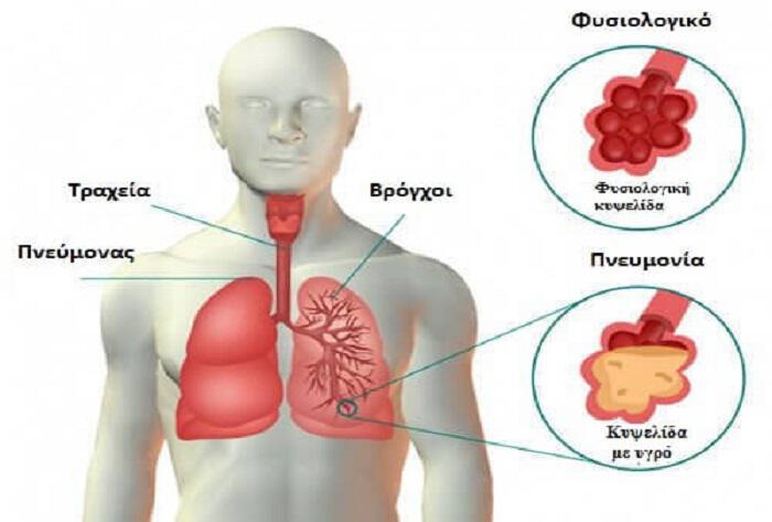 Πνευμονία: Αιτίες, συμπτώματα, πρόληψη, εναλλακτική αντιμετώπιση