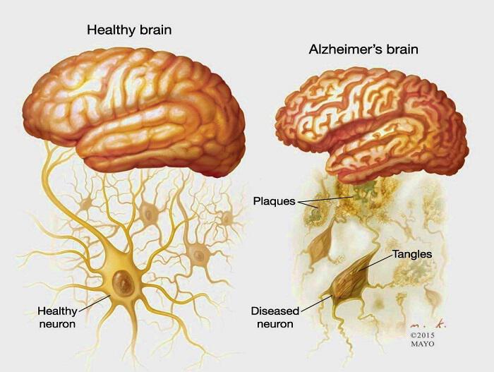 Αλτσχάιμερ: Μια ασθένεια ανεπάρκειας θρεπτικών ουσιών