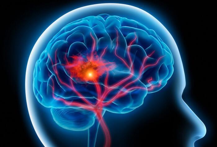 Πως σχετίζονται χοληστερόλη-στατίνες, με εγκέφαλο και Αλτσχάιμερ