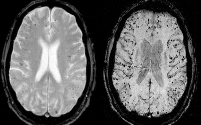 Αργίλιο-Αλουμίνιο, εμπλέκεται στον εκφυλισμό εγκεφάλου και νευρικού συστήματος