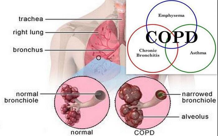 Οι ασθένειες των πνευμόνων-ΧΑΠ: Βρογχίτιδα, Εμφύσημα, Βρογχεκτασία και Άσθμα