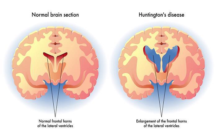 Nόσος του Huntington: Αιτίες, συμπτώματα, αντιμετώπιση