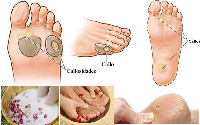 Κάλοι-Τύλοι-Ρόζοι στα πόδια: Φυσική αντιμετώπιση και γιατροσόφια