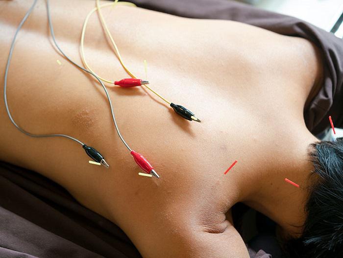Ηλεκτροβελονισμός: Μια σύγχρονη φυσική μέθοδος "αυτοθεραπείας".