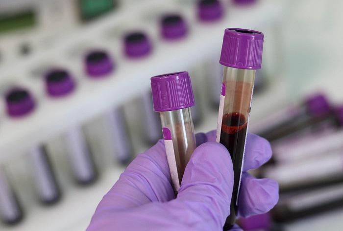 Το αίμα ασθενών που ανάρρωσαν από τον COVID-19 μπορεί να σώσει ζωές