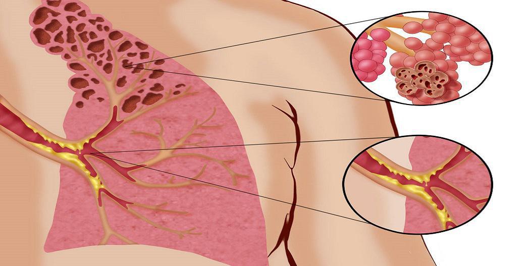 6 φυσικοί τρόποι αντιμετώπισης της Χρόνιας Αποφρακτικής Πνευμονοπάθειας