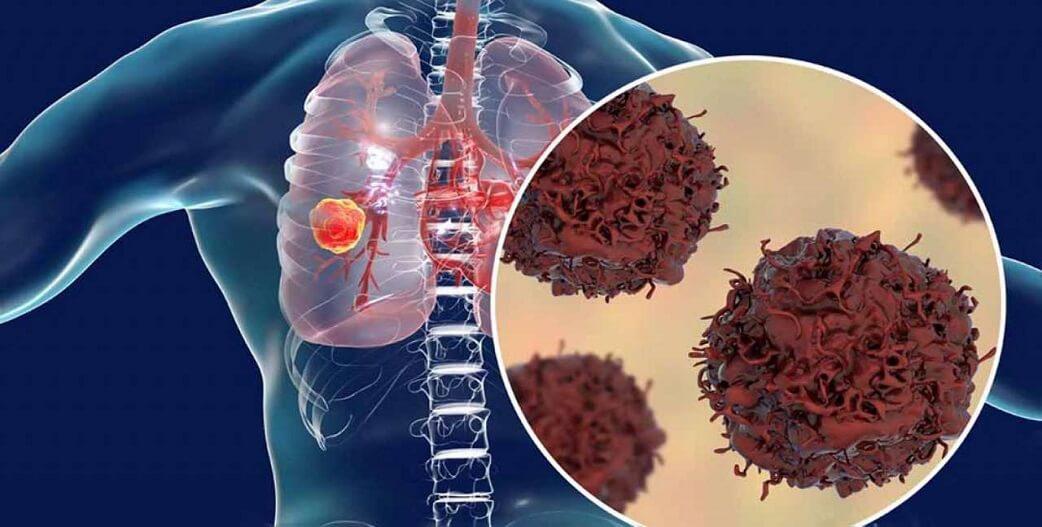 Καρκίνος του πνεύμονα: Η καψαϊκίνη μπορεί να εμποδίσει την μετάσταση