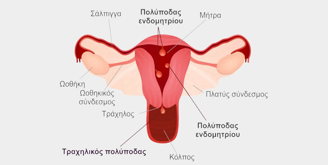 Πολύποδες ενδομητρίου: Αιτίες, συμπτώματα, διάγνωση και αντιμετώπιση