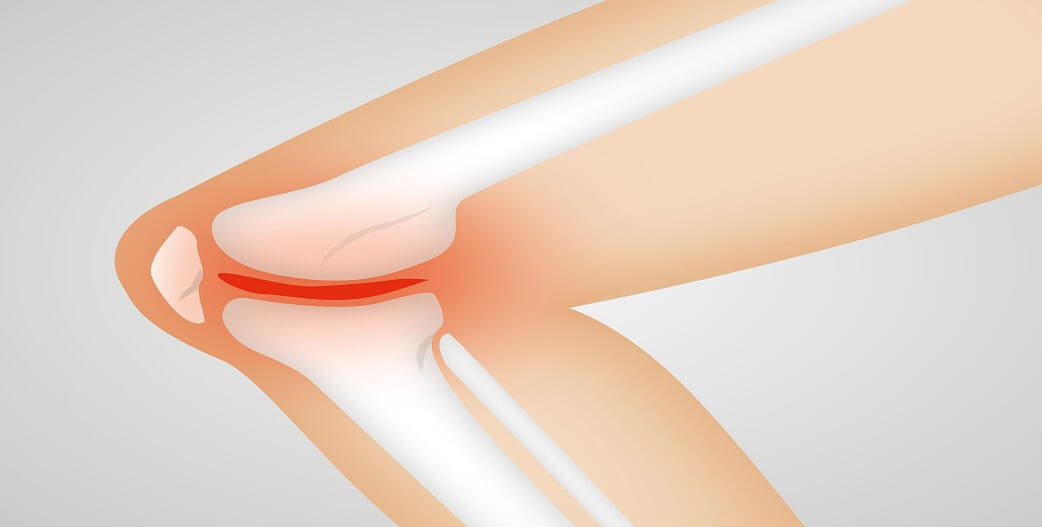 Πόνος στο γόνατο: Πρόληψη και Αντιμετώπιση