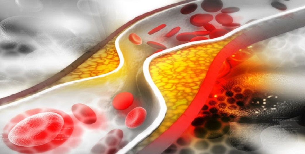Πώς να απομακρύνετε την χοληστερίνη από τα αιμοφόρα αγγεία