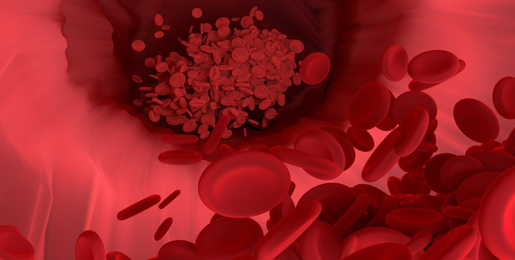 Θρόμβος αίματος σε αρτηρία ή φλέβα: Τί συμβαίνει στην κάθε περίπτωση και πρόληψη