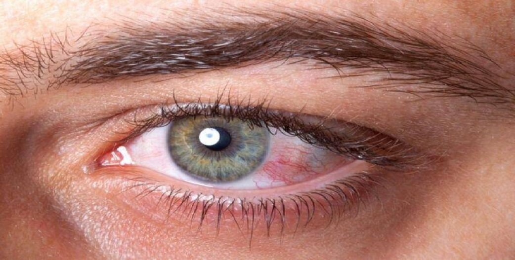 Τί μπορεί να σημαίνει η αλλαγή χρώματος στο άσπρο των ματιών
