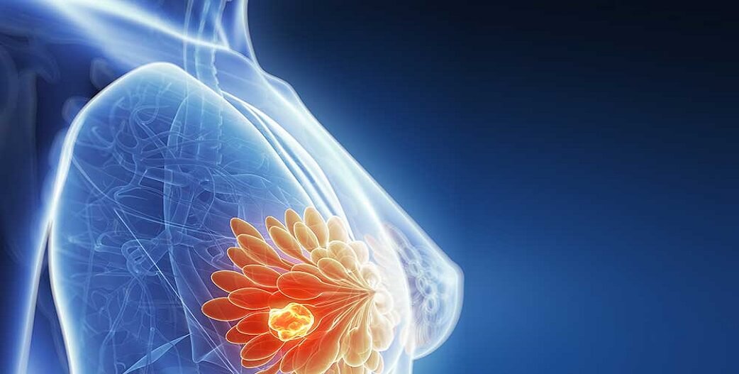 Μικροβίωμα: Σύνδεση εντέρου με τον καρκίνο του μαστού και την μετάστασή του