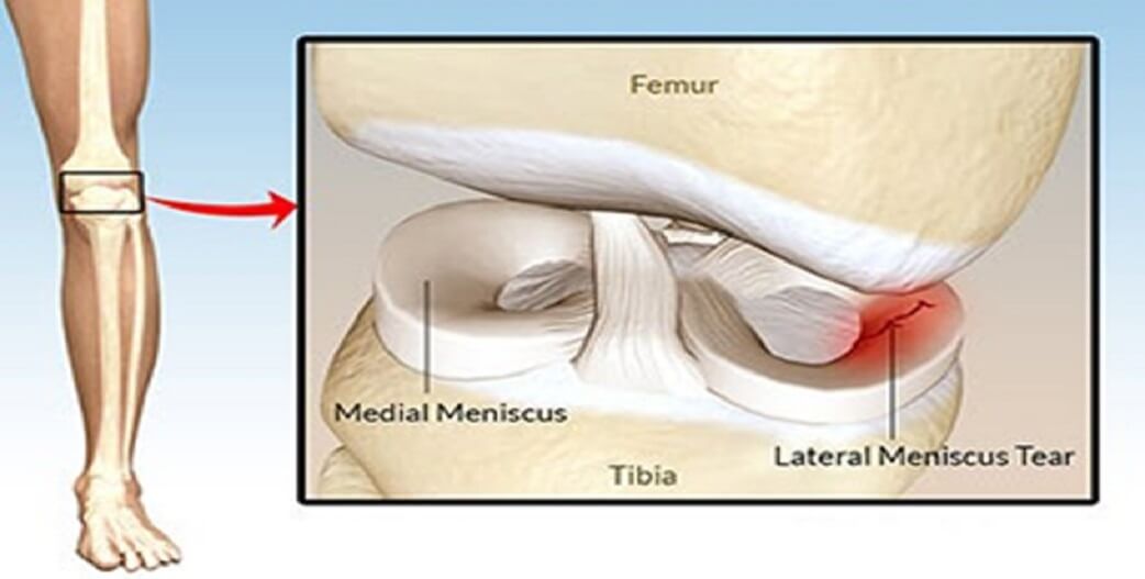 Ρήξη μηνίσκου στο γόνατο: Χειρουργείο ή φυσικοθεραπεία με ειδικές θεραπευτικές ασκήσεις;