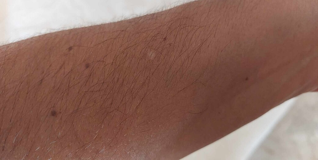 Τί είναι αυτές οι άσπρες κηλίδες στο δέρμα μου;