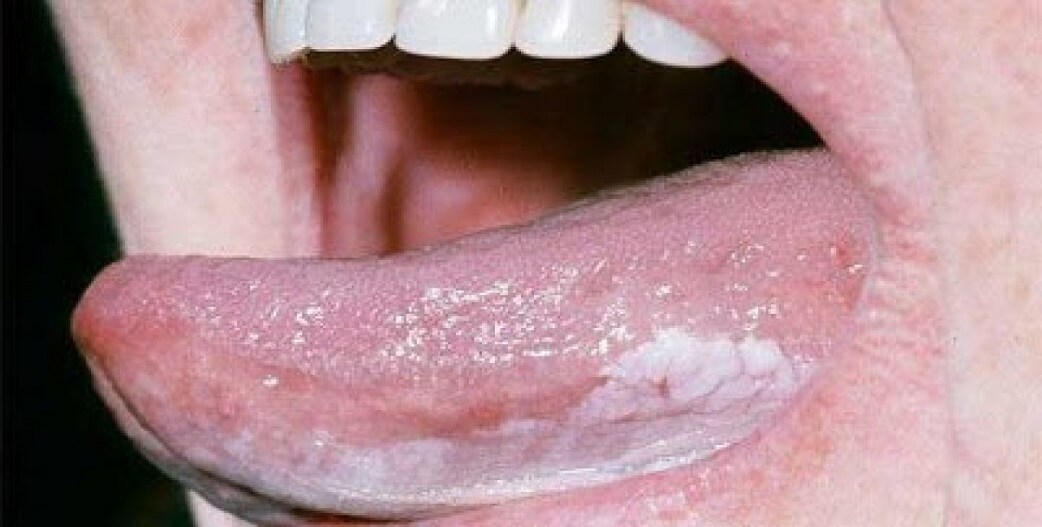 Λευκοπλακία: Προκαρκινική βλάβη στο στόμα που πρέπει να αντιμετωπίζεται