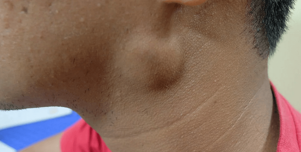 Γρομπαλάκια στο δέρμα: Πρόληψη και πότε πρέπει να δράσετε