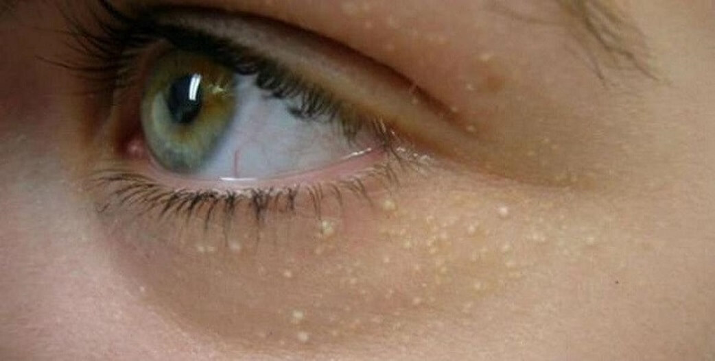 Λευκά σπυράκια γύρω από τα μάτια: Τί είναι και γιατί δεν πρέπει να τα σπάμε